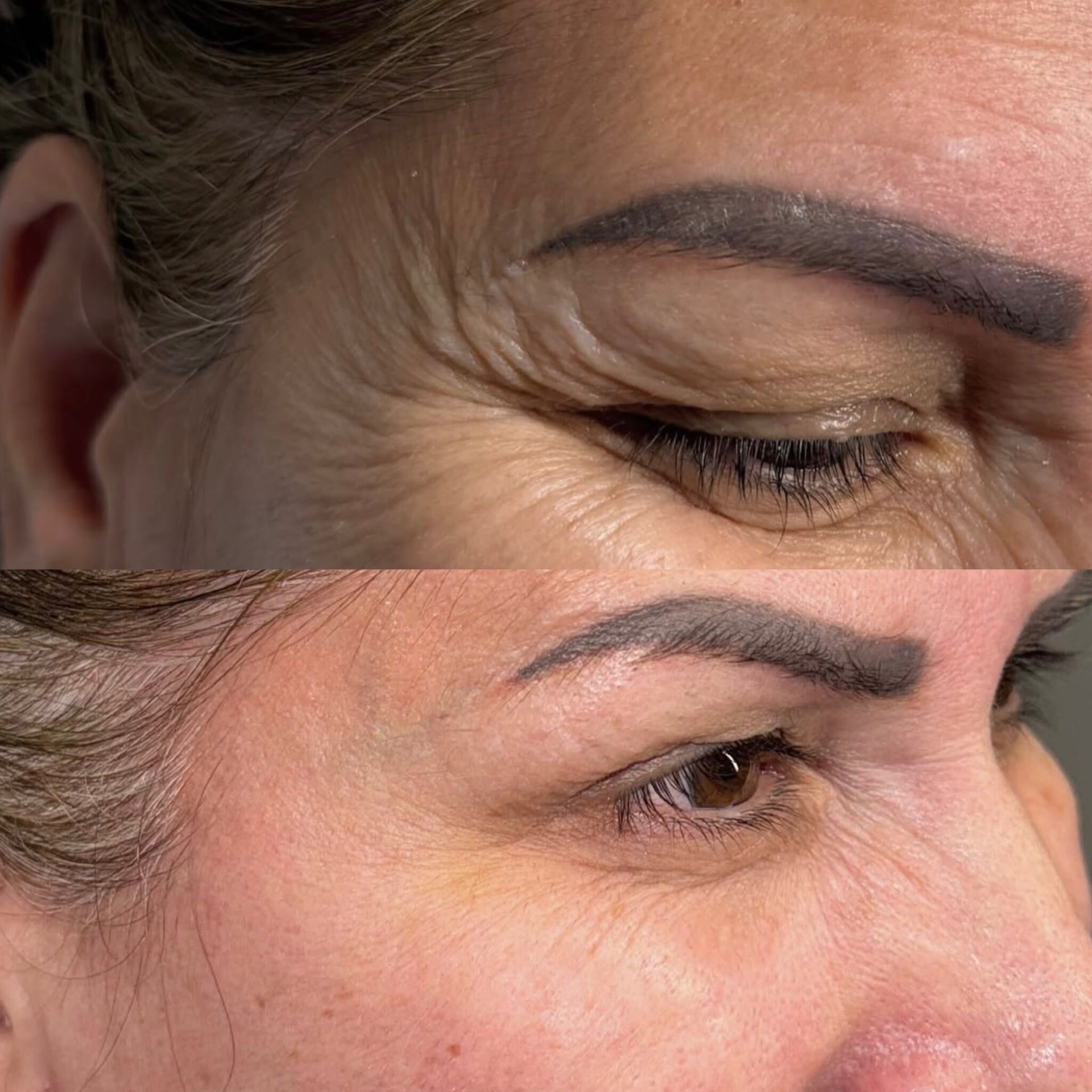 Before and after result — Anti-wrinkle · eye area at The Aesthetics Shed