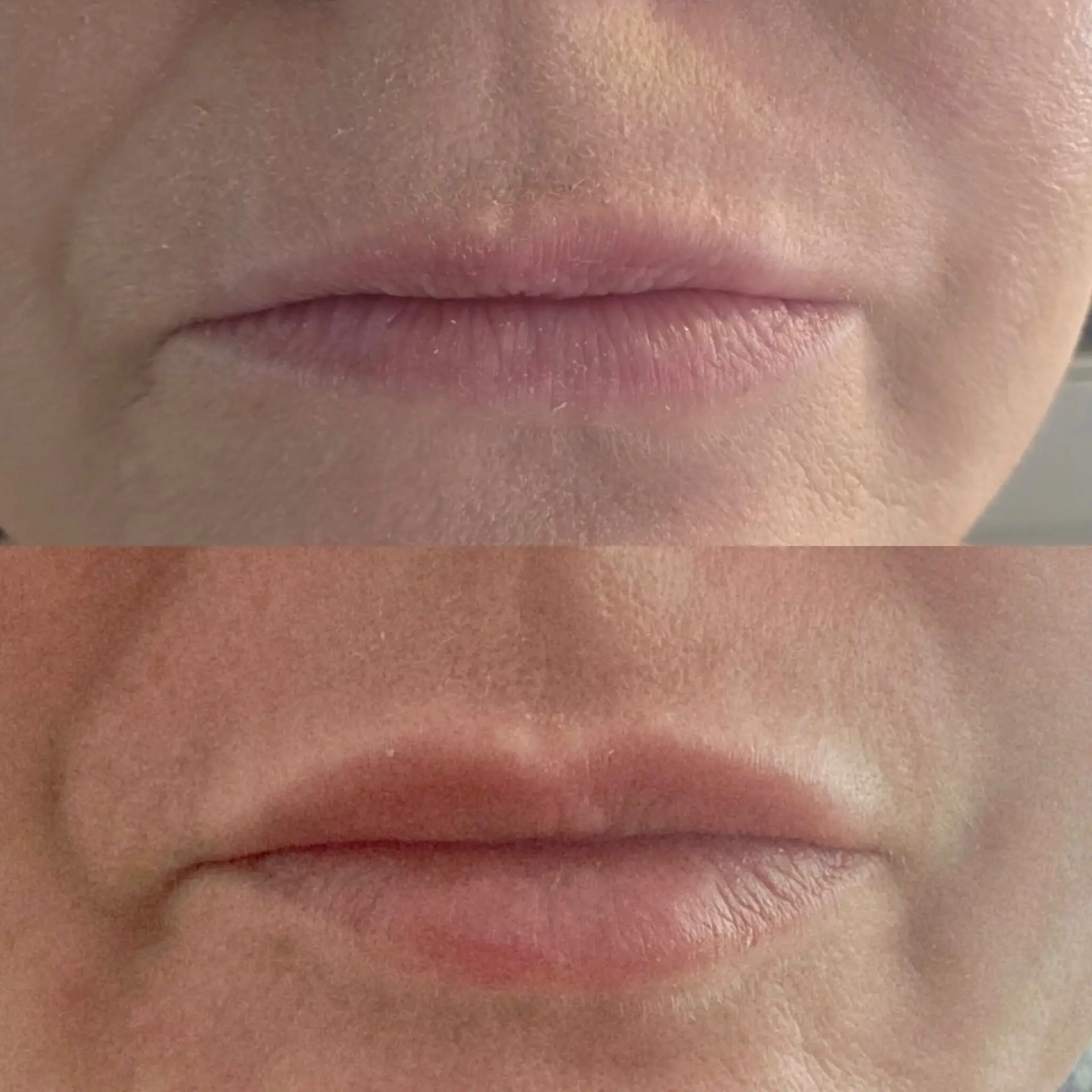 Before and after result — Dermal filler · lip enhancement at The Aesthetics Shed
