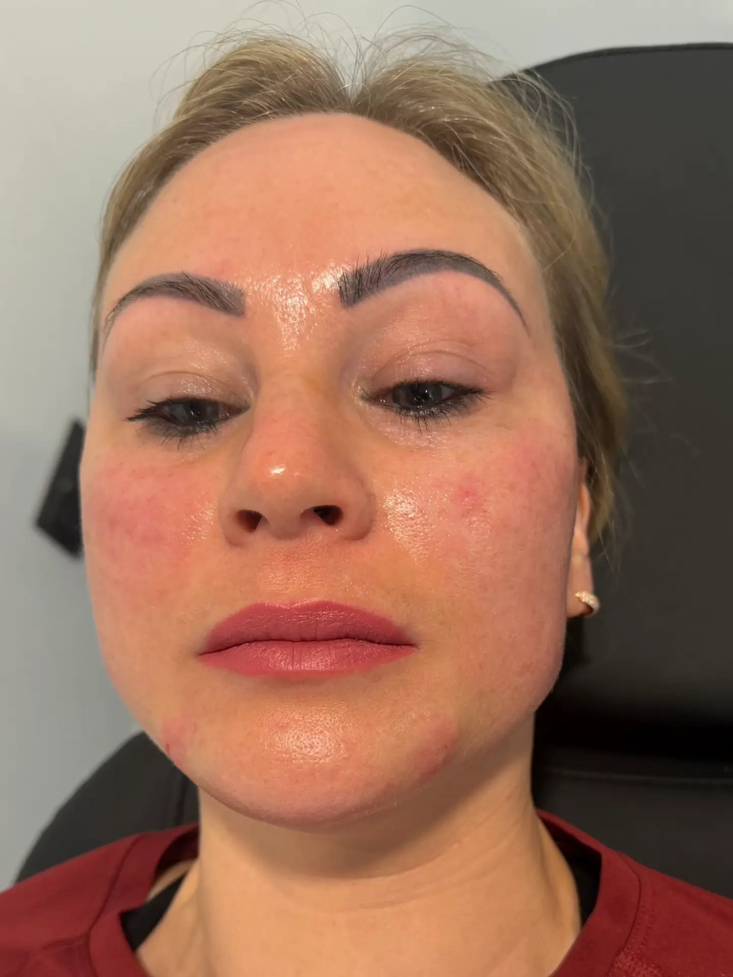 Before and after result — Skin booster at The Aesthetics Shed